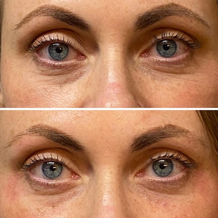 Connie Brennan Eye Wrinkles Before and After Example