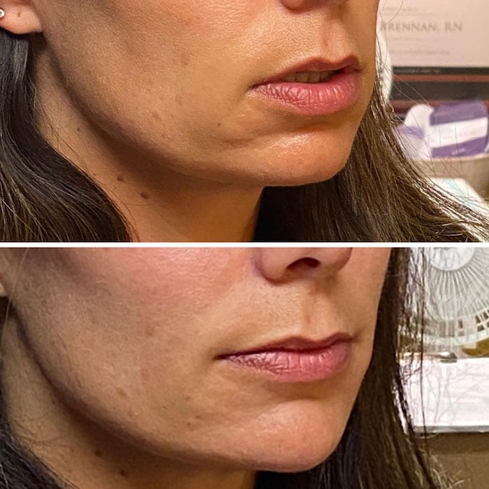 Beautiful Lip and Chin Improvements via Aesthetic Enhancements from Connie Brennan.