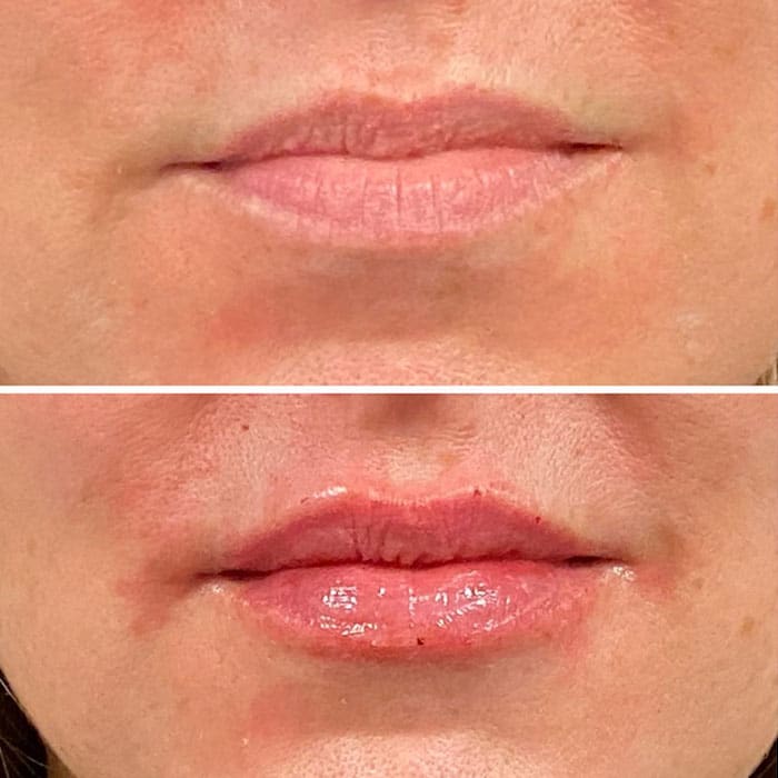 Lip Filler Example from Connie Brennan Aesthetic Enhancements.